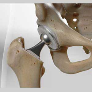 hip replacement surgery