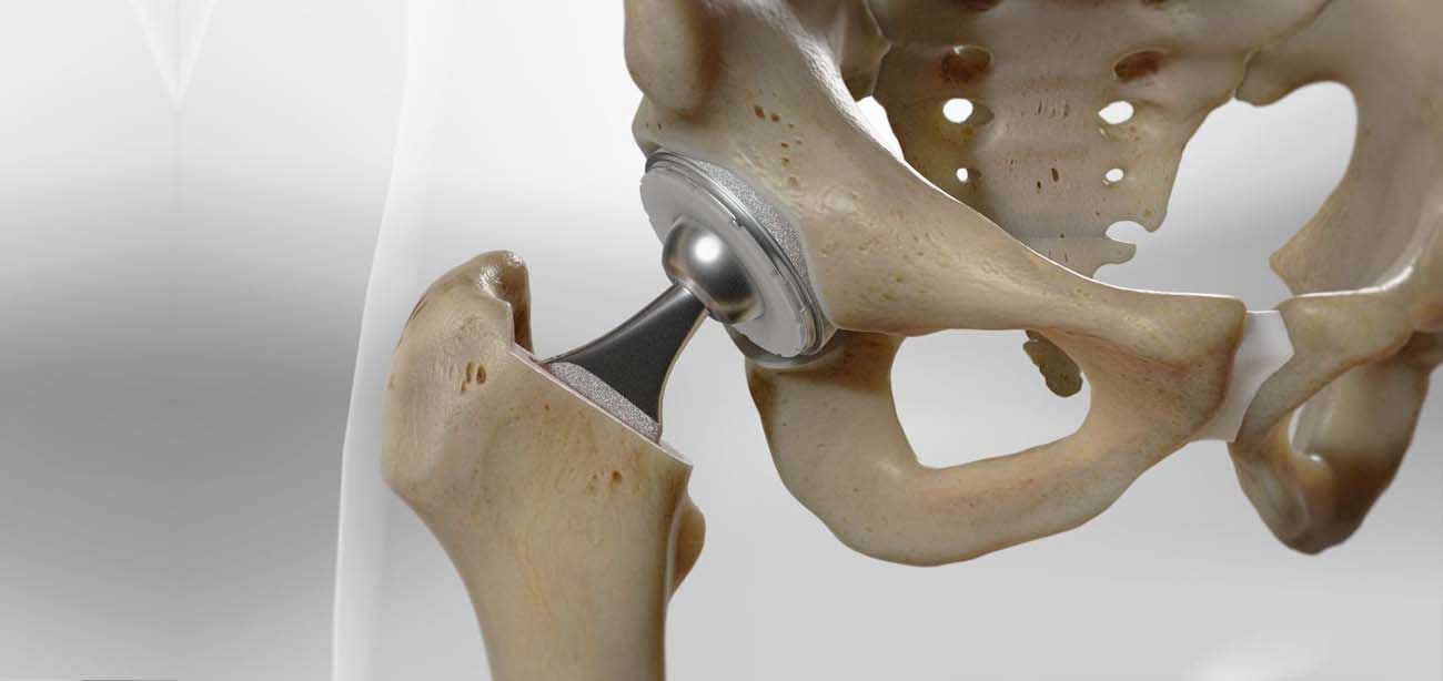 replaces the old joint with an artificial joint (prosthesis)