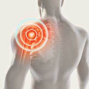 joint replacement surgery
