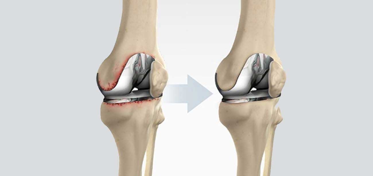 doctor performing revision knee joint replacement